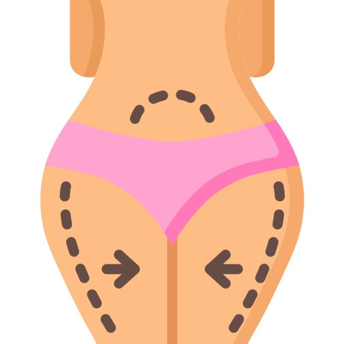 Abdominoplasty