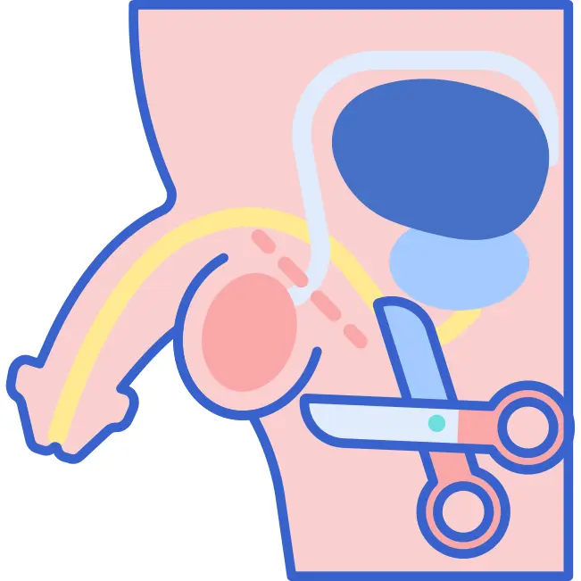 Vasectomy