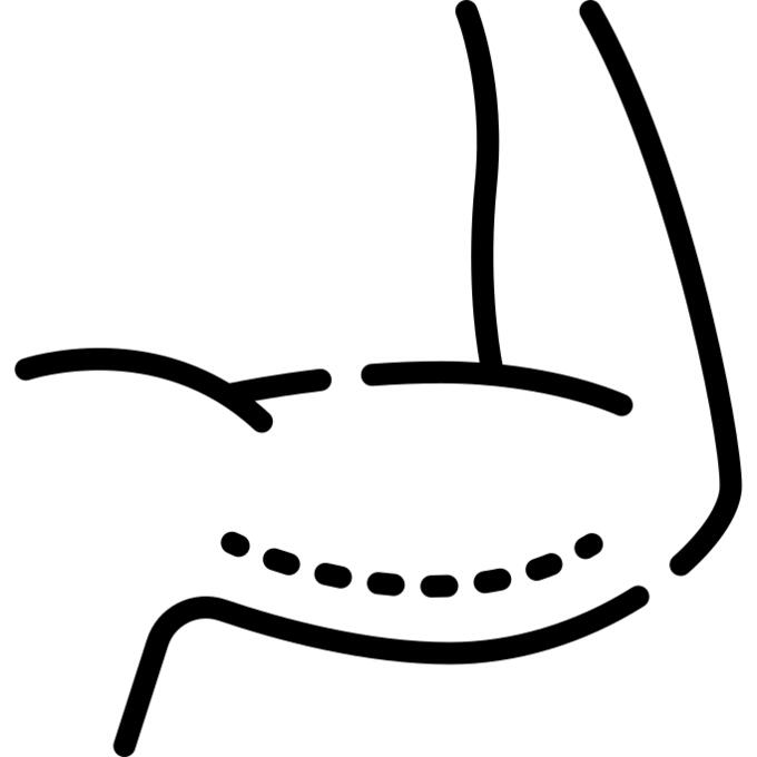 Brachioplasty