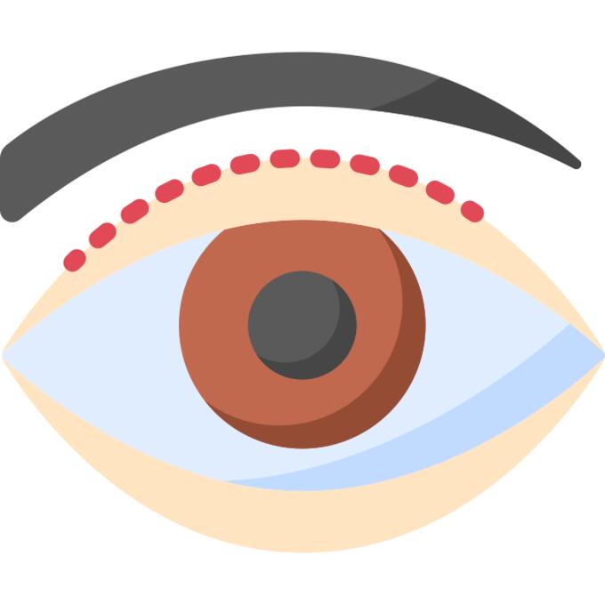 Blepharoplasty