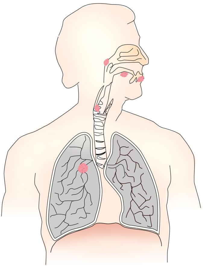 Symbol for lung cancer vector image