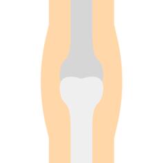 骨质疏松