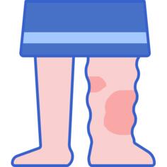 Lymphedema