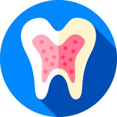 Root canal