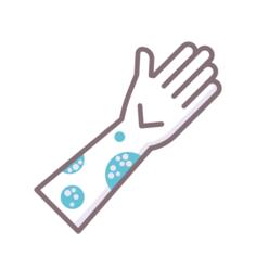 Eczema