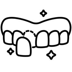 Dental veneer