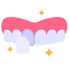 Dental veneer